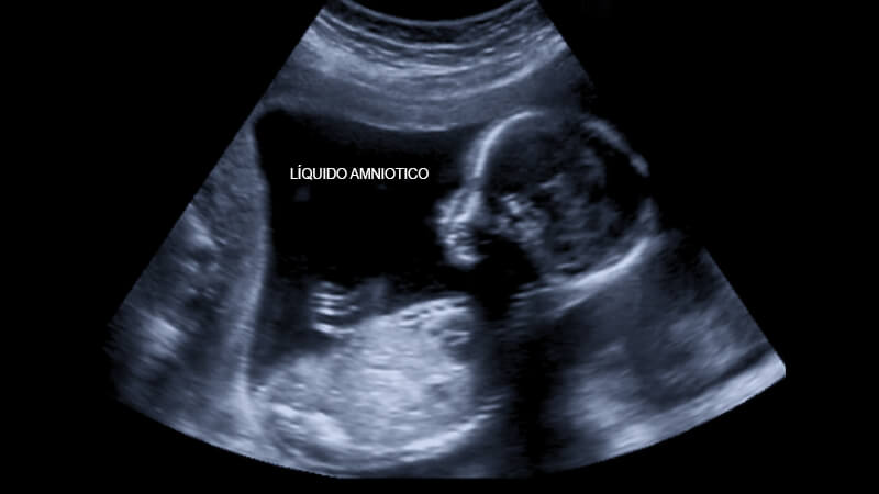 ultrasonido, ecografía, embarazo, líquido amniótico