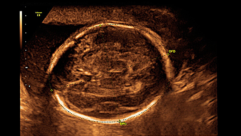 ultrasonido, ecografía, embarazo, circunferencia cefálica
